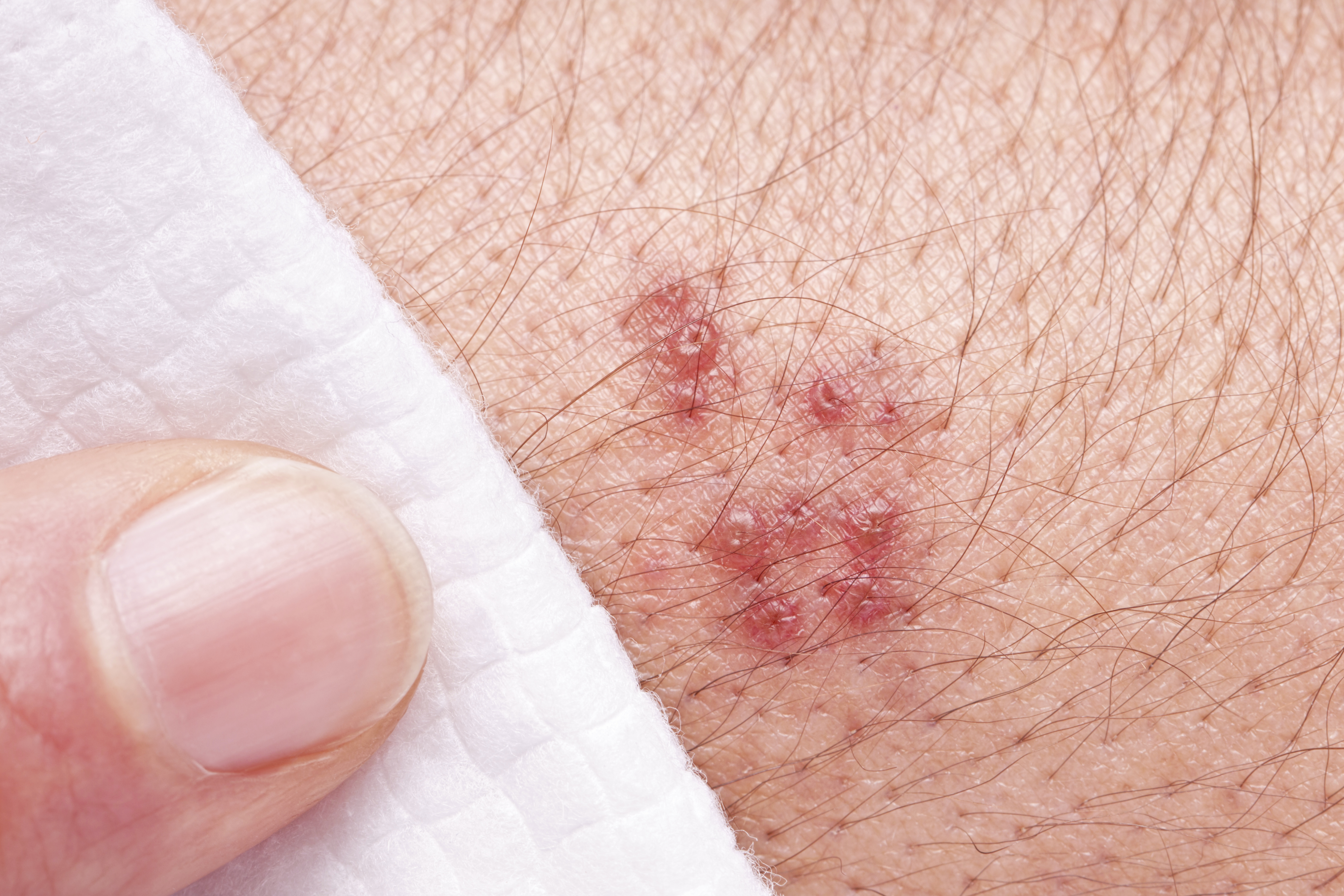 Symptoms Of Herpes Sores Or Rashes - The Body
